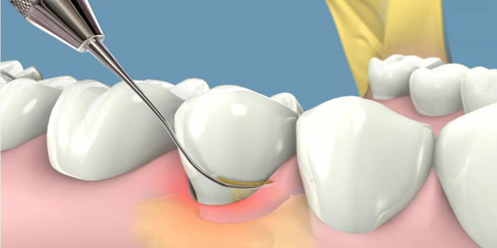 periodoncia dental en getafe